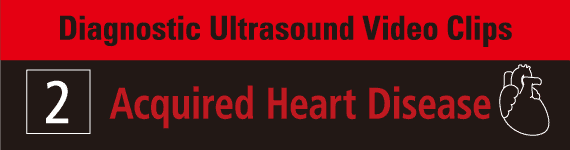 Diagnostic Ultrasound Video Clips 2- Acquired Heart Disease