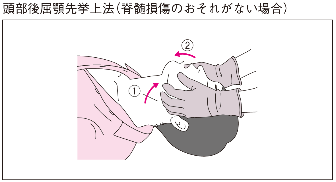 頭部後屈 誤りの図