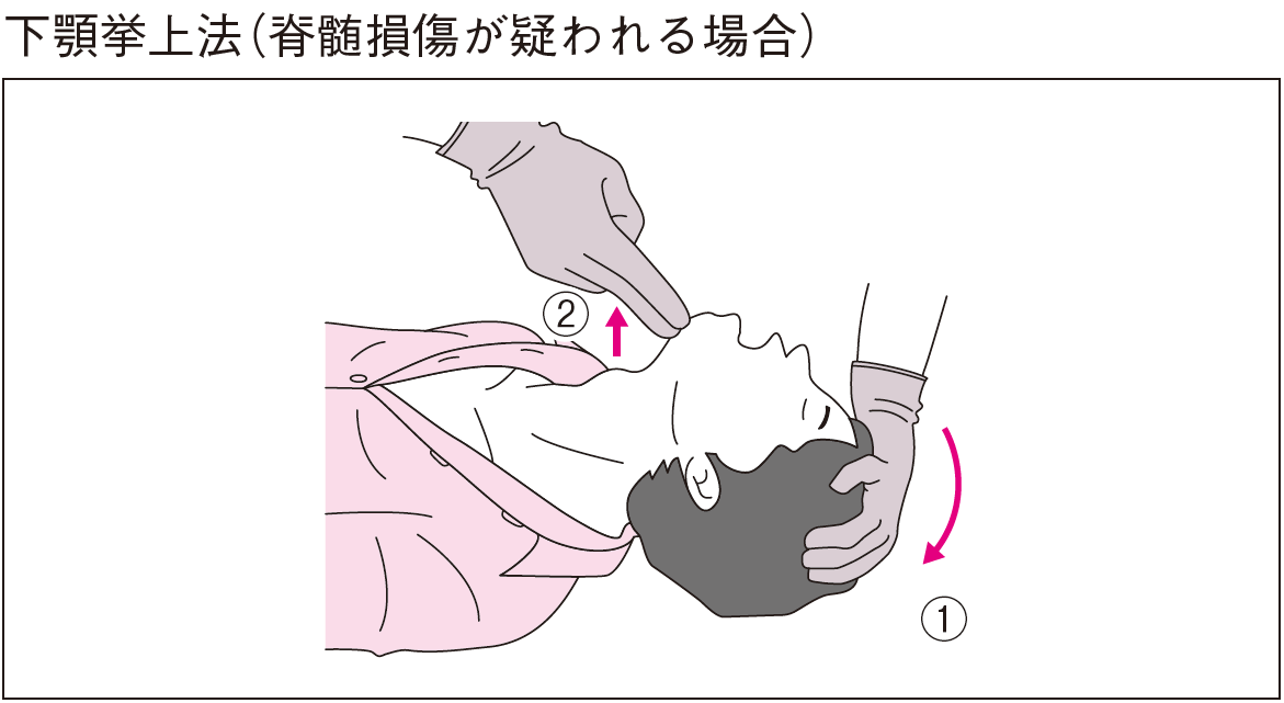 下顎挙上 誤りの図